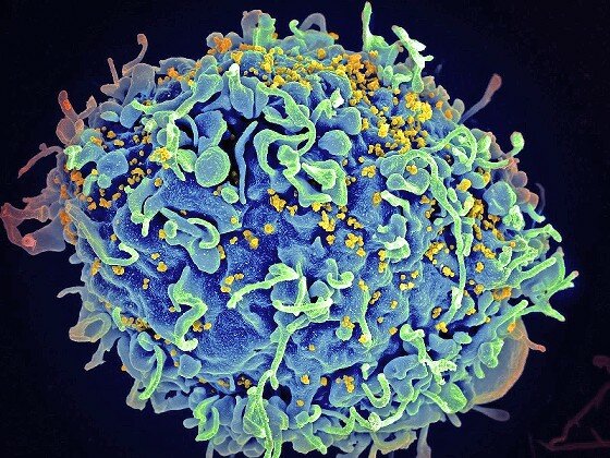 HIV virus (yellow) infecting a human cell.