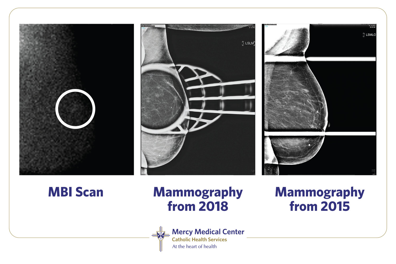 Mercy Medical Center displayed photos of Carlson’s previous mammography screenings beside her MBI, which shows its precision, compared to traditional technologies.