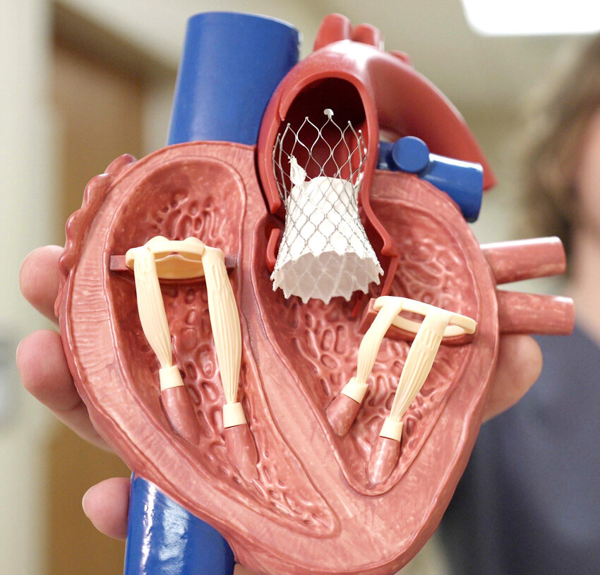 A model of a heart with a TAVR valve is pictured.
