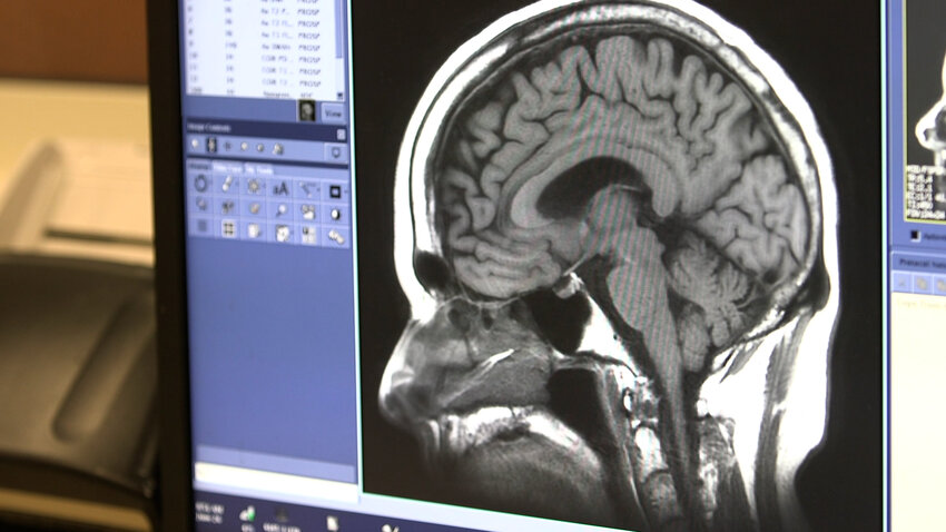 A brain scan used by clinical experts and researchers at Banner Alzheimer&rsquo;s Institute to better understand the disease, as well as other forms of dementia.