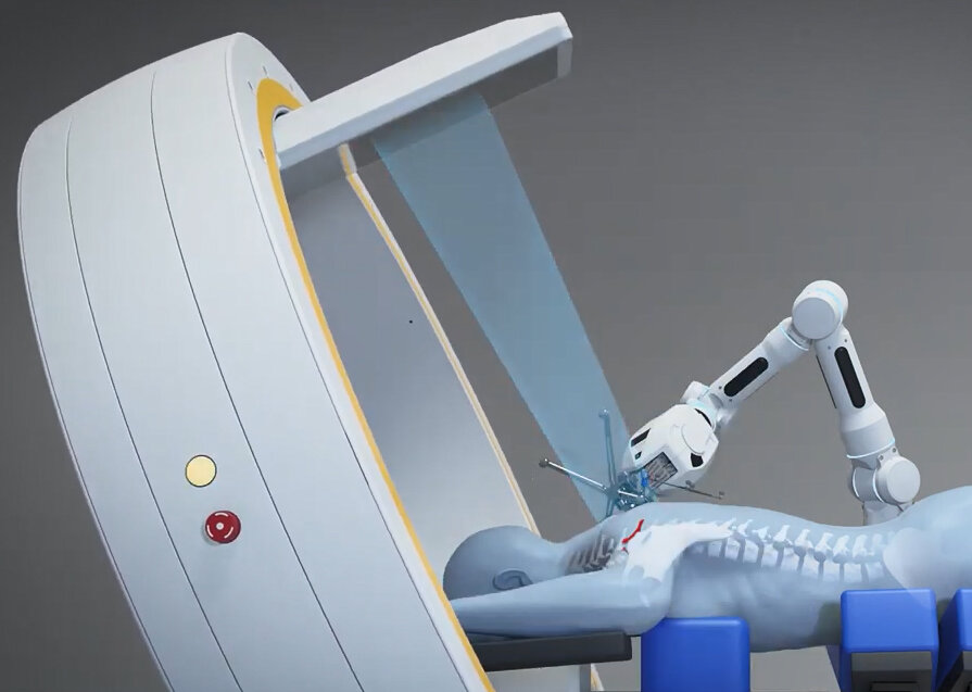 The Loop-X robotic system moves around the patient and includes 2D and 3D CT imaging, Brainlab navigation software to guide a robotic arm for placing instruments and hardware during spine surgery.