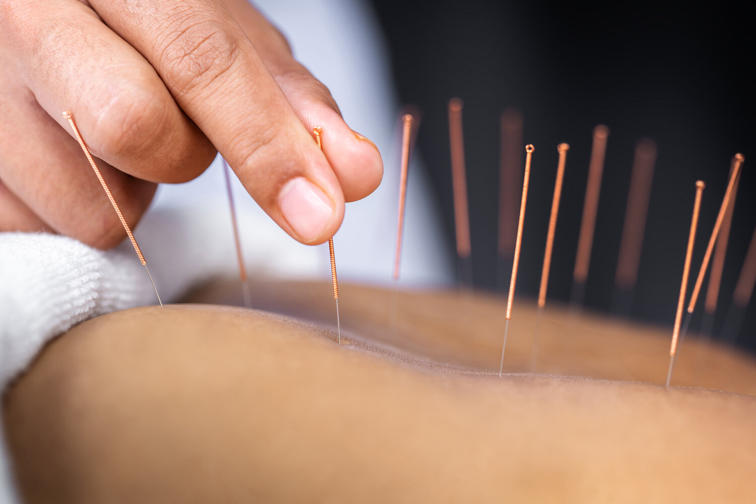 Curious about acupuncture? A Peoria doctor explains - Peoria